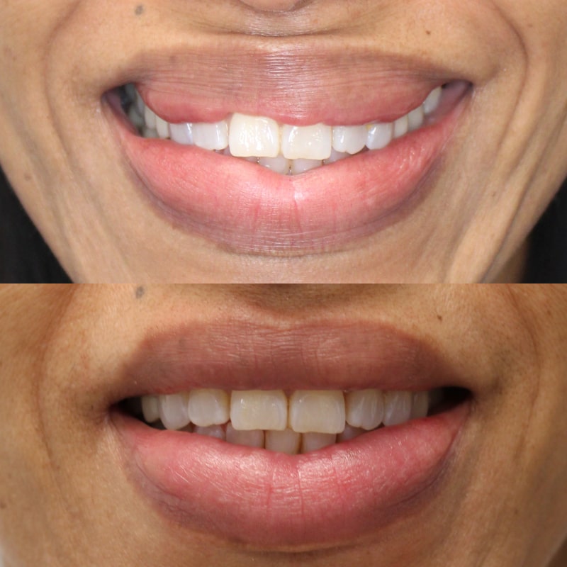Biopolymers Lips Before & After Image