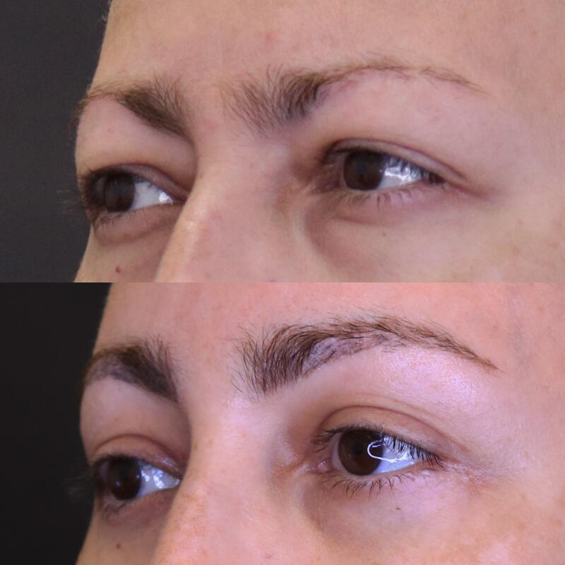 Eyebrow Transplant Before & After Image