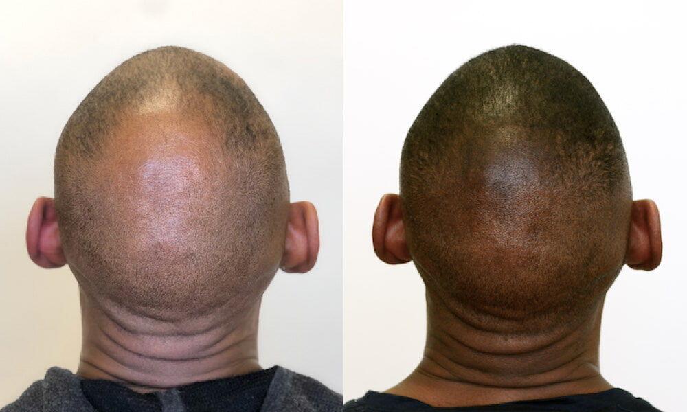 Scalp Micropigmentation Before & After Image