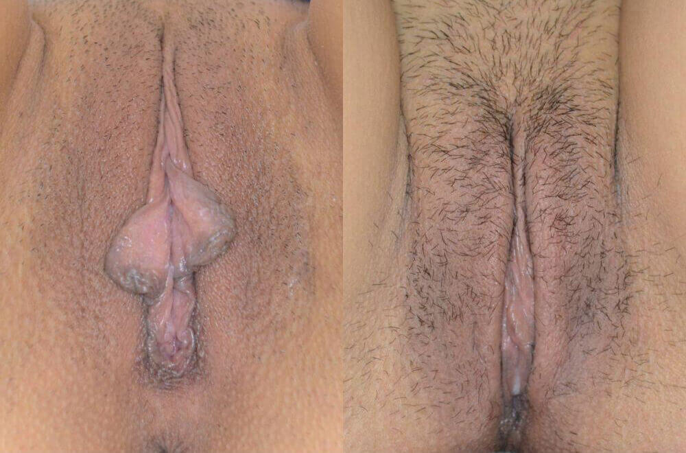 labiaplasty before & after image