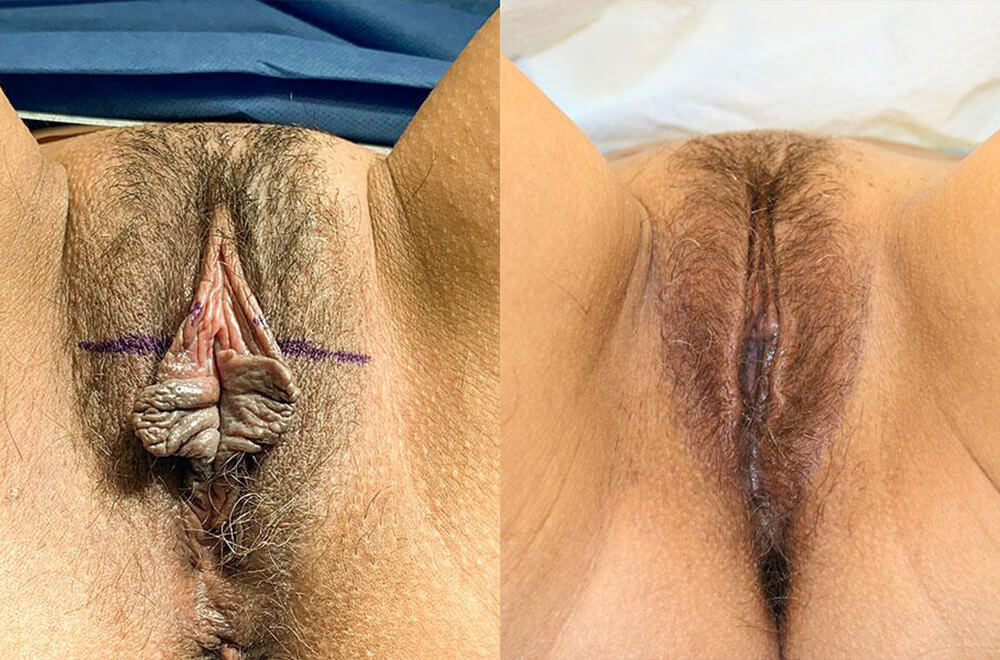 labiaplasty before & after image