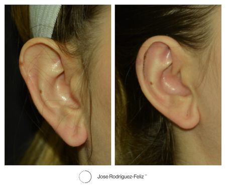 If You Have Ever Wanted Smaller Ears, Macrotia Ear Surgery Is For You