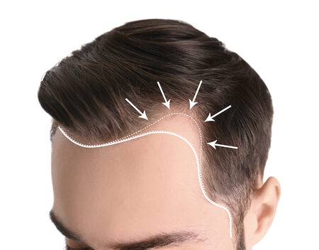 You Can Get Hair Restoration