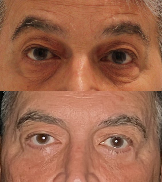 Blepharoplasty Before & After Image