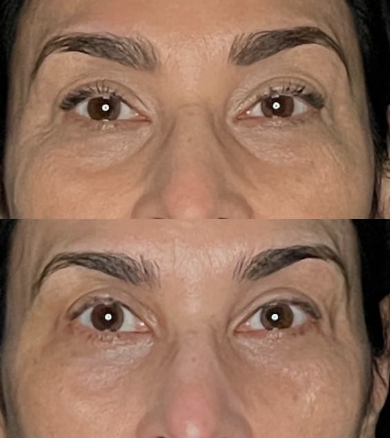 Blepharoplasty Before & After Image