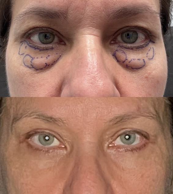Blepharoplasty Before & After Image