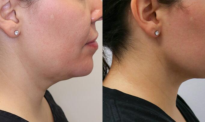 Jawline Contouring Before & After Image