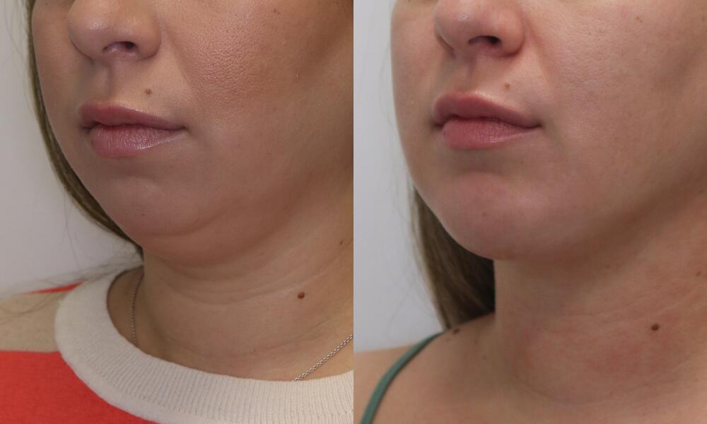 Jawline Contouring Before & After Image