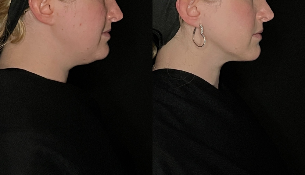 Jawline Contouring Before & After Image