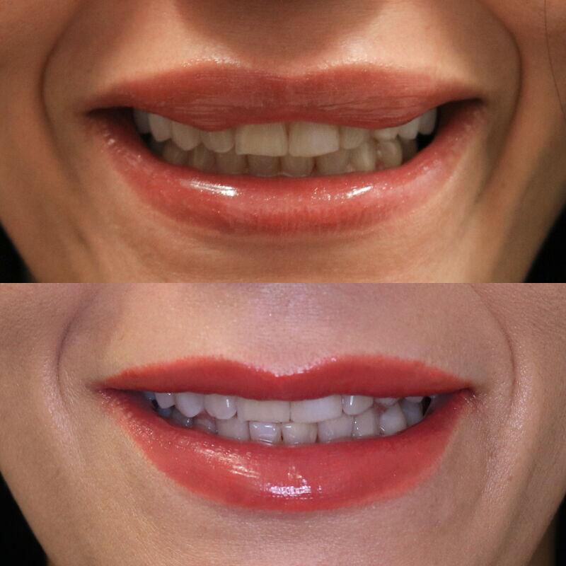 Biopolymers Lips Before & After Image