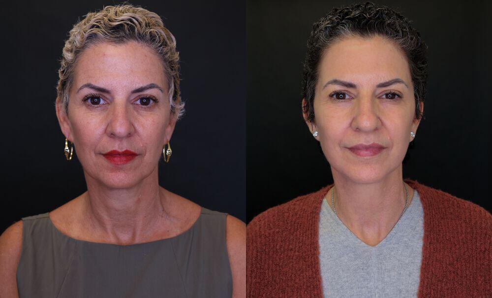 Facelift Before & After Image