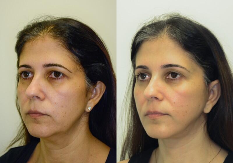 Facelift Before & After Image