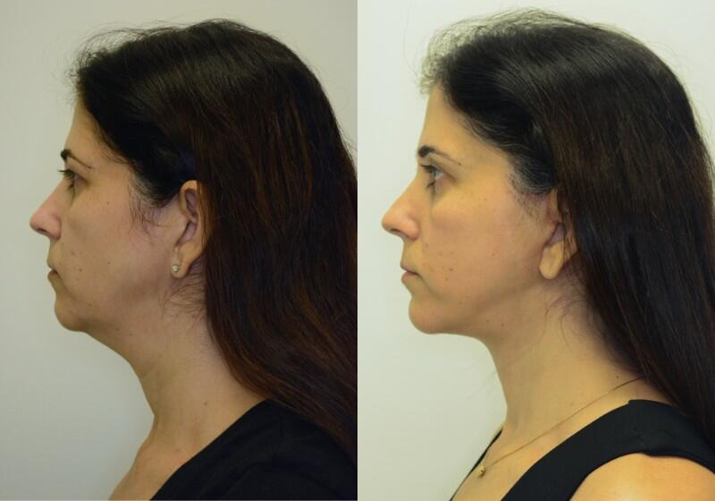 Facelift Before & After Image