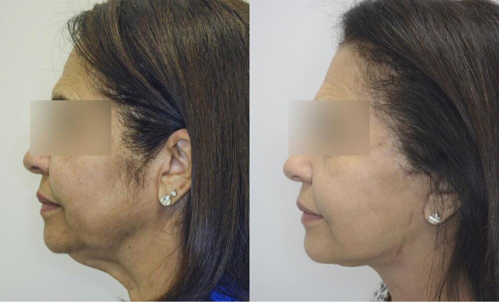 Facelift Before & After Image