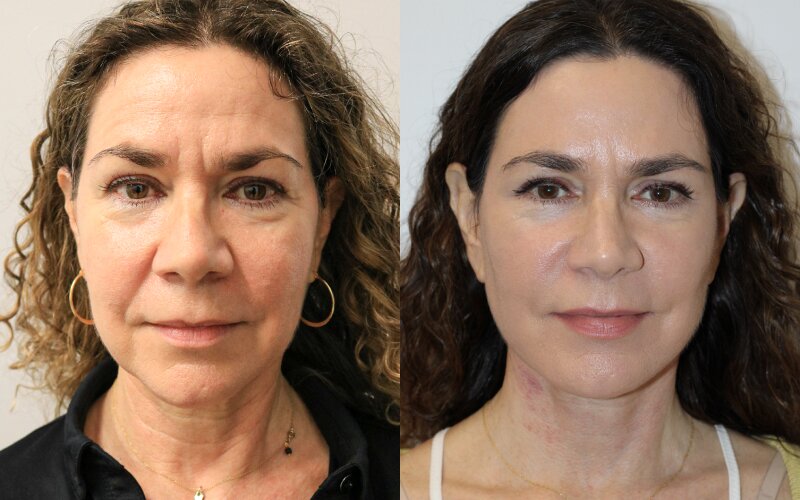 Facelift Before & After Image