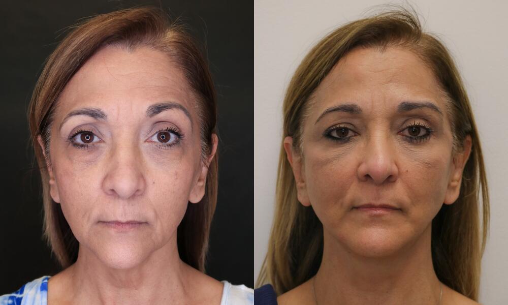 Neck Lift Before & After Image