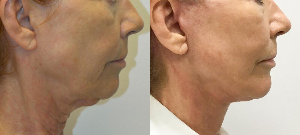 Neck Lift Before & After Image
