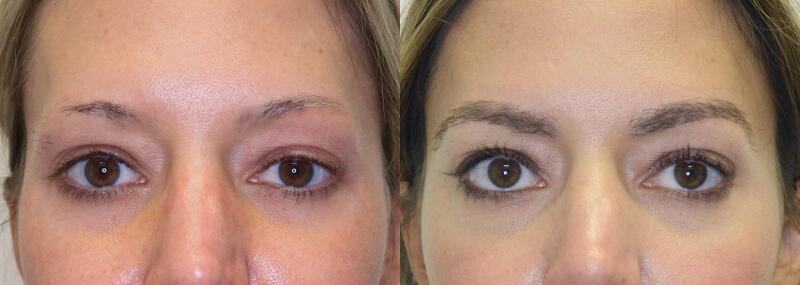 Eyebrow Transplant Before & After Image