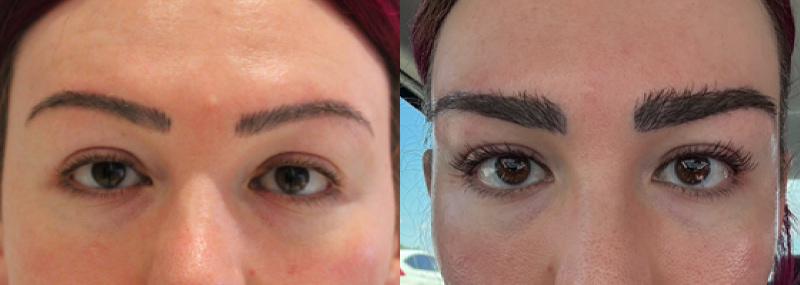 Eyebrow Transplant Before & After Image