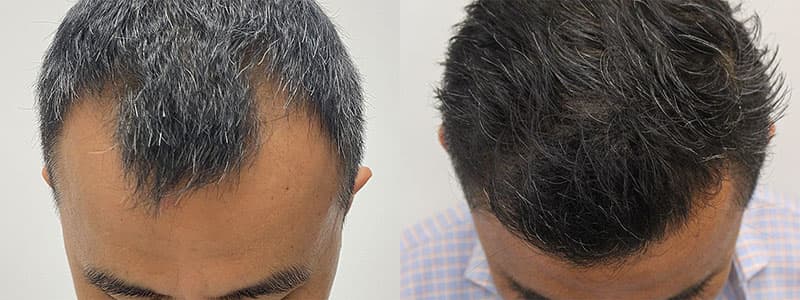 Hair Transplant Before & After Image