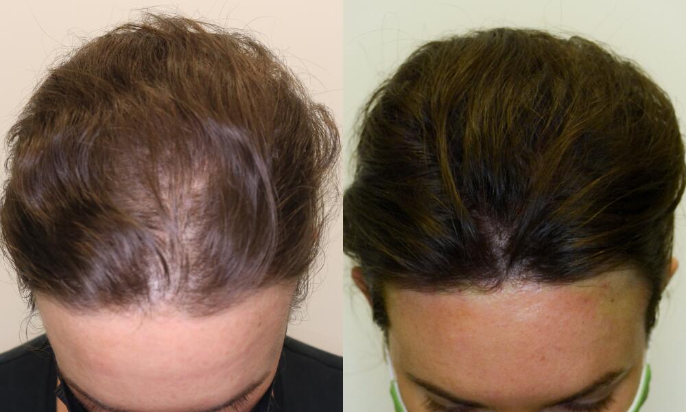 PRP Before & After Image