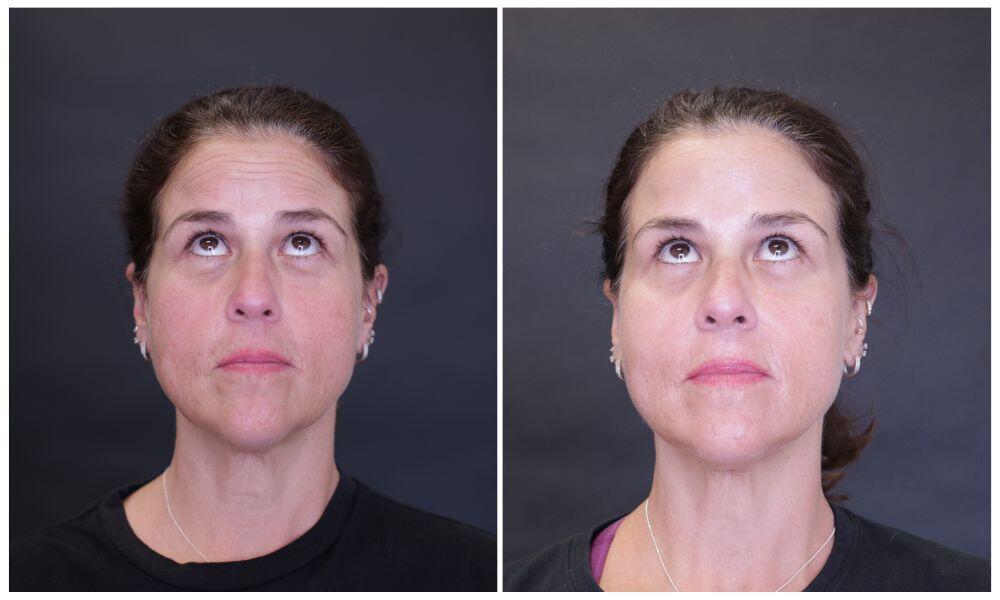 Botox & Dysport Before & After Image