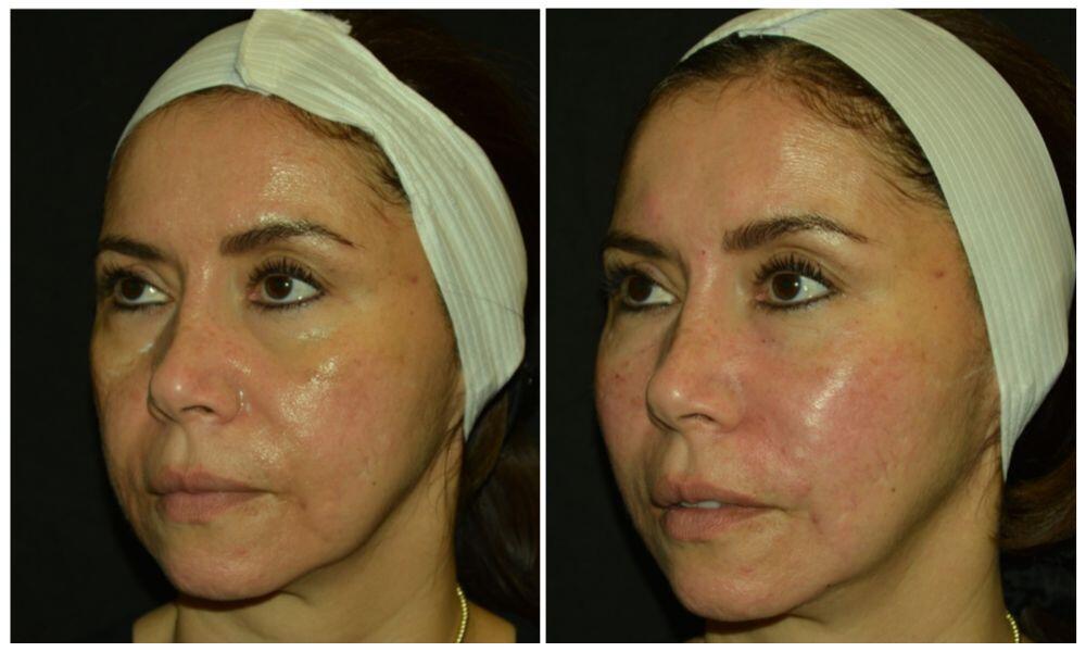 Facial Fillers Before & After Image