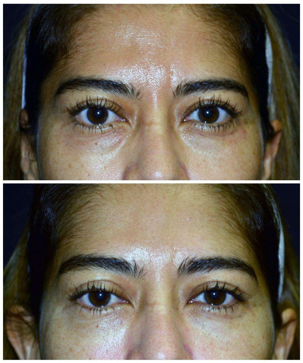 Under Eye Fillers Before & After Image